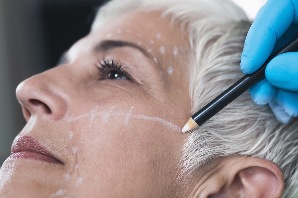 	
Close-up of an older woman’s face with surgical markings as a gloved hand draws lines, illustrating preparation for a cosmetic procedure highlighting Facelift Benefits and Risks.