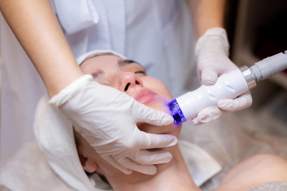 A woman lies on a treatment chair with her eyes closed while a professional in gloves performs microneedling for wrinkles on her cheek.